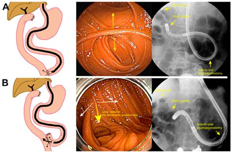 Successful Intubation Using a Cap-Assisted Colonoscope for Endoscopic ...