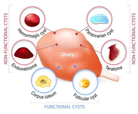 Pre-menopausal Ovarian Cysts: what causes them, how they're ...