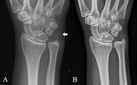 Calcium hydroxyapatite deposition disease: Imaging features and ...