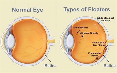 Image result for Eye Floater Types