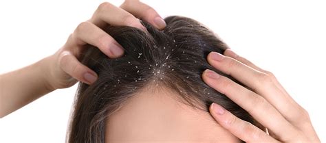 Know Why Dandruff Gets Worse During Winters – Re'equil