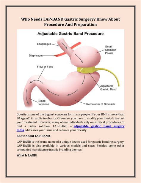 PPT - Who Needs LAP-BAND Gastric Surgery Know About Procedure And Preparation PowerPoint ...