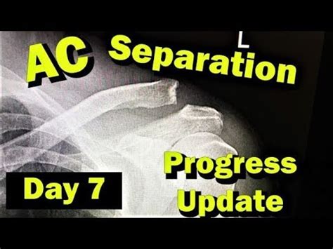 Image result for AC Step Defect