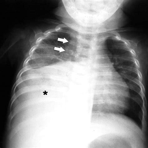 Tuberculosis X Ray Cavitation