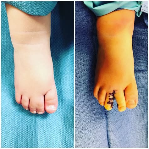 Webbed Feet On Humans