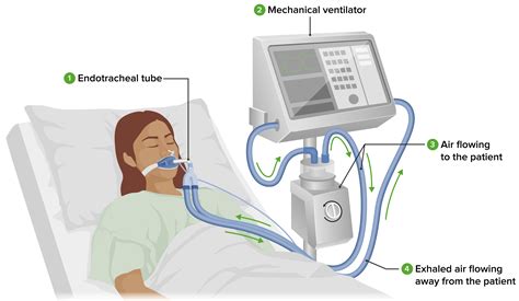 Endotracheal Tube And Ventilator