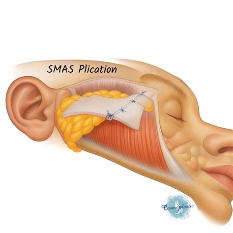 Understanding the SMAS: What Every Cosmetic Surgeon Must Know ...