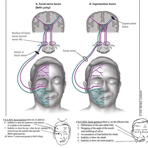 Facial Droop Cranial Nerve Stroke at Kimberly Marte blog