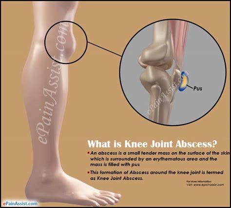 Image result for Exploding Massive Knee Abscess