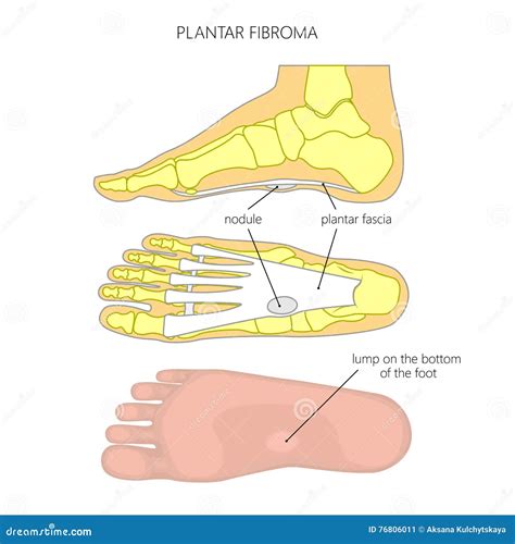 Plantar fibroma stock vector. Illustration of disease - 76806011