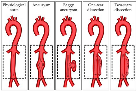 Cellular, Molecular and Clinical Aspects of Aortic Aneurysm—Vascular ...