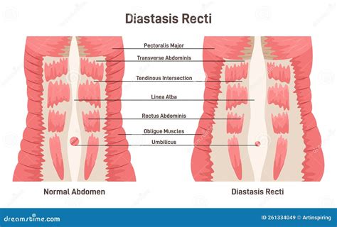 Diastasis Rect. Abdominal Muscles Separation Stock Vector ...