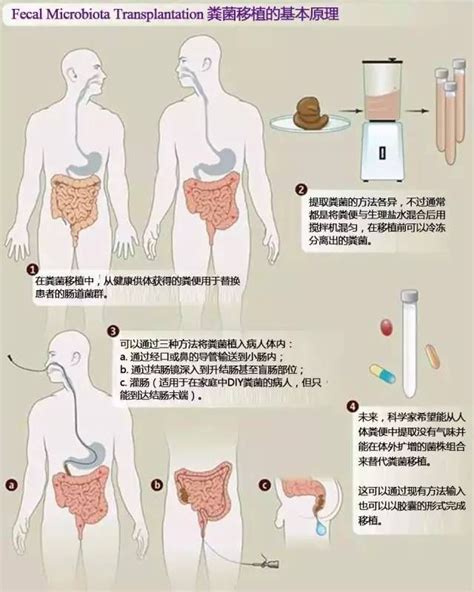 什么是粪菌移植,粪菌移植适应症,粪菌移植怎么做,粪菌移植后注意事项-无癌家园