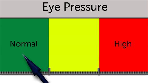 Intraocular Pressure Normal Glaucoma Fact Sheet – Vista Center For