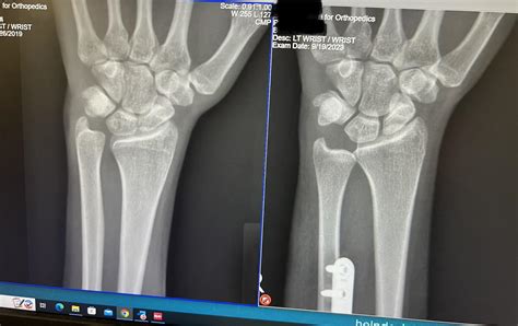 Ulnar shortening osteotomy before/after : r/Radiology