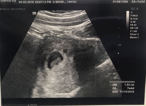 9 Week Abdominal Ultrasound