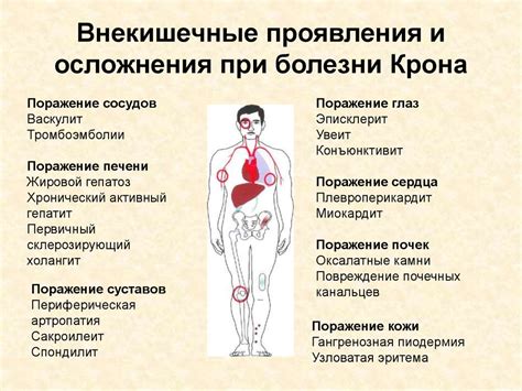 Хронический колит - презентация онлайн