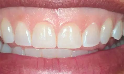 Botulinum toxin type A injections helpful for long-term resolution of ...