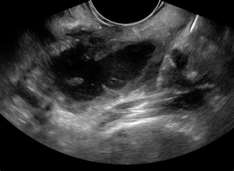Bedside Ultrasound for the Diagnosis of Peritonsillar Abscess - JETem