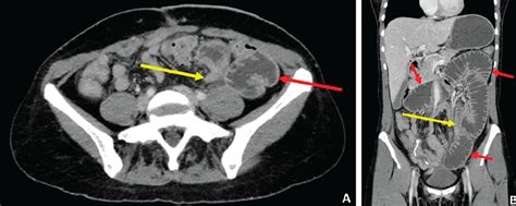 Image result for CT Scan with Contrast
