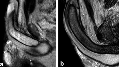 What Is Priapism, A Condition in Men, And Can It Occur While Sleeping?
