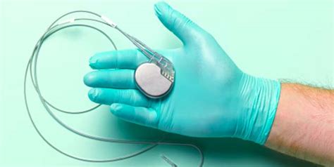 Pacemaker Follow-up Guidelines | OnlyMyHealth