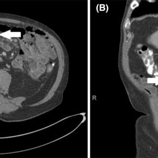 Image result for CT Scan with Contrast