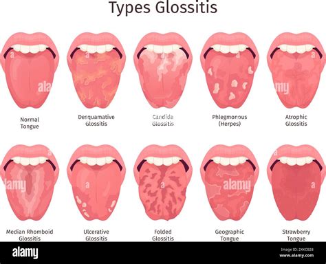 Glossitis. Scarlet tongue disease types, human mouth sore teeth problem healthy or sick ...