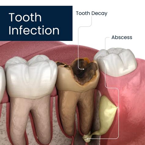 Azithromycin Abscess Tooth