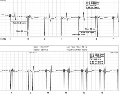 Image result for Pacemaker Programming