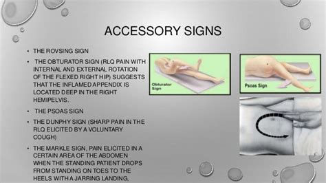 Image result for Appendicitis Assessment Signs