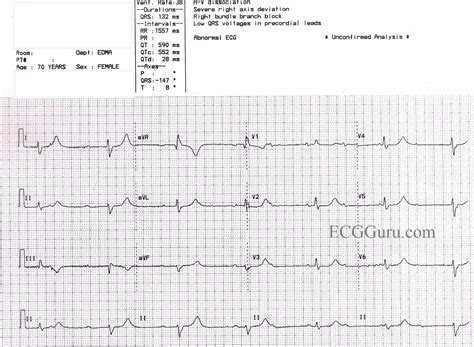 Ventricular Escape Rhythm