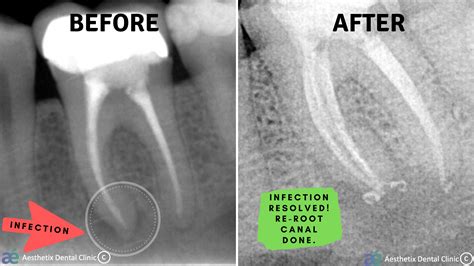 Root Canal Infection Xray