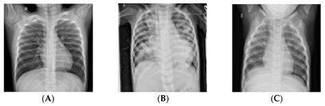 PneumoniaNet: Automated Detection and Classification of Pediatric ...