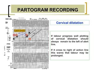 Image result for Partogram Examples
