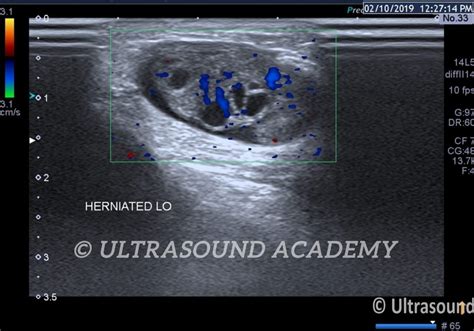 UTERINE INGUINAL HERNIA – Case By Dr. Nitin Jadhav