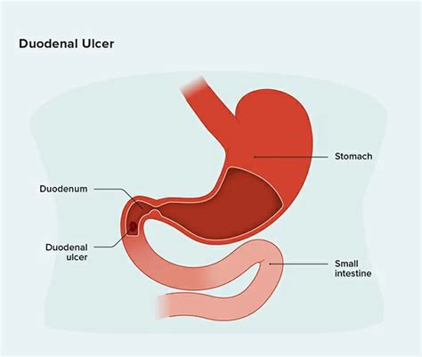 Peptic Ulcer, Ulcerative Colitis & Duodenal Ulcer