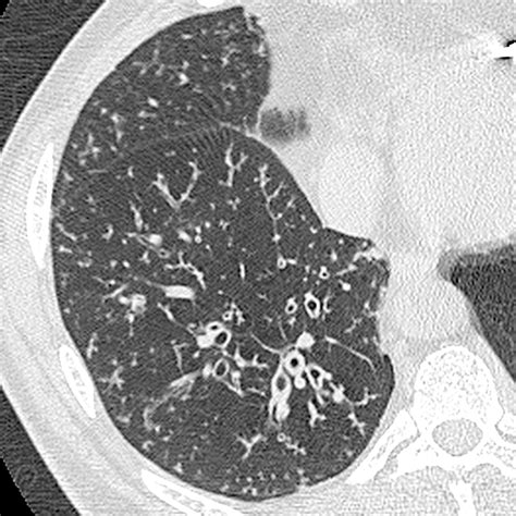 Bronchiolitis: A Practical Approach for the General ...