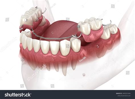 Removable Partial Denture Mandibular