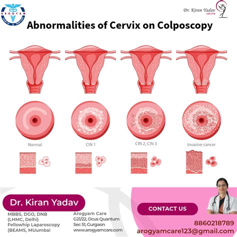 Colposcopy - gynelap.com