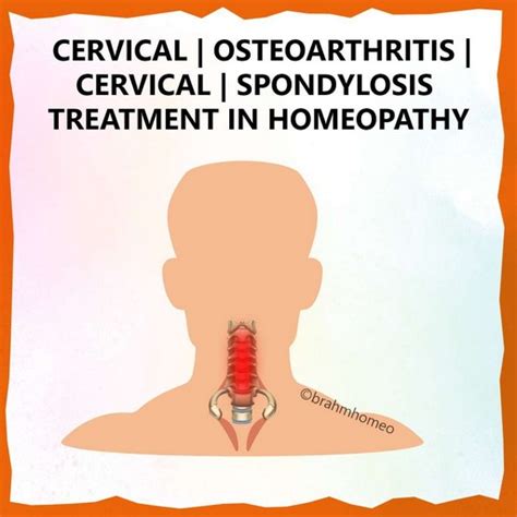 Cervical Osteoarthritis | Cervical Osteoarthritis Treatment | Cervical ...
