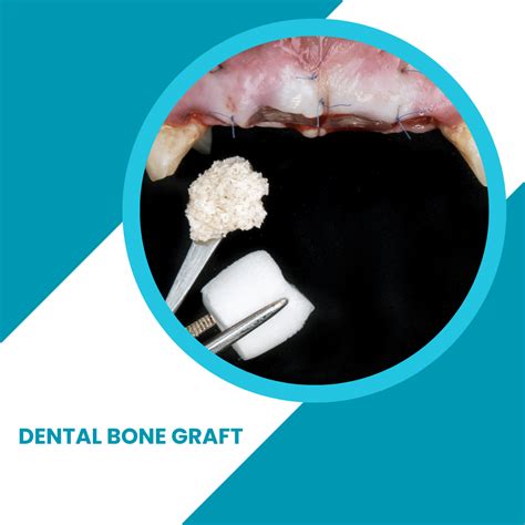 Dental Bone Graft - How much does a dental bone graft cost?