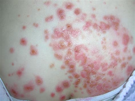 Skin Rash From Bacteria – Bacterial Rash Treatment – OHYDHC