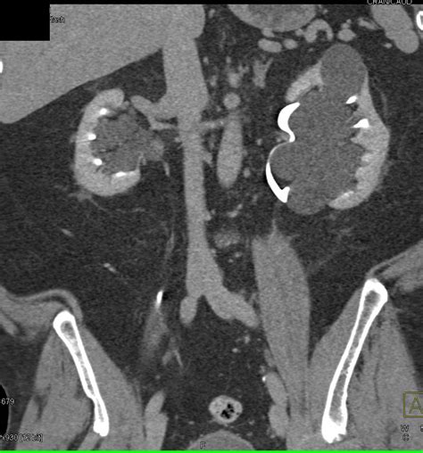 Kuvatulokset haulle parapelvic cyst kidney