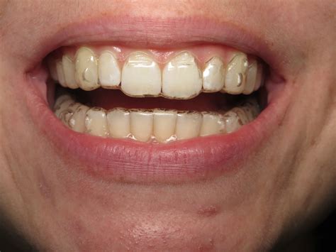 Invisalign Buttons 的图像结果