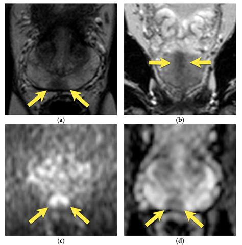 Mri Prostate Cancer Probability Can MRIs Replace Confirmatory