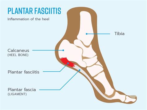 Plantar Fasciitis 的图像结果