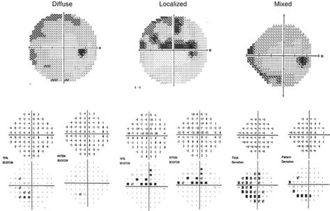 Image result for Peripheral Vision Test Results