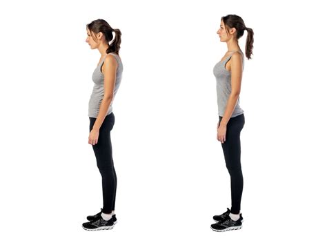 Swayback Posture Risks and Treatment