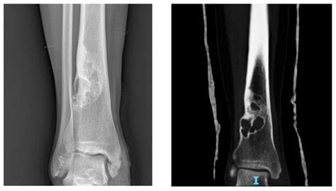 Benign Bone Tumors: An Overview of What We Know Today